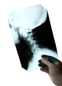 Radiographie d'un rachis cervical de profil gauche