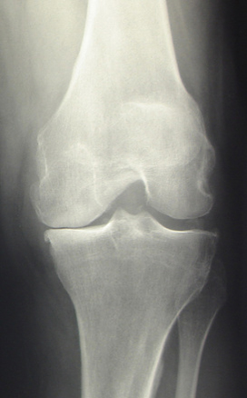 Radiographie d'un genou