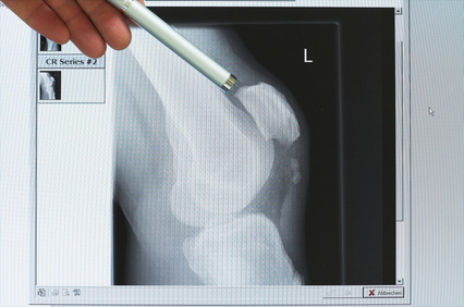 Radiographie d'un genou avec un stylo qui pointe vers la rotule